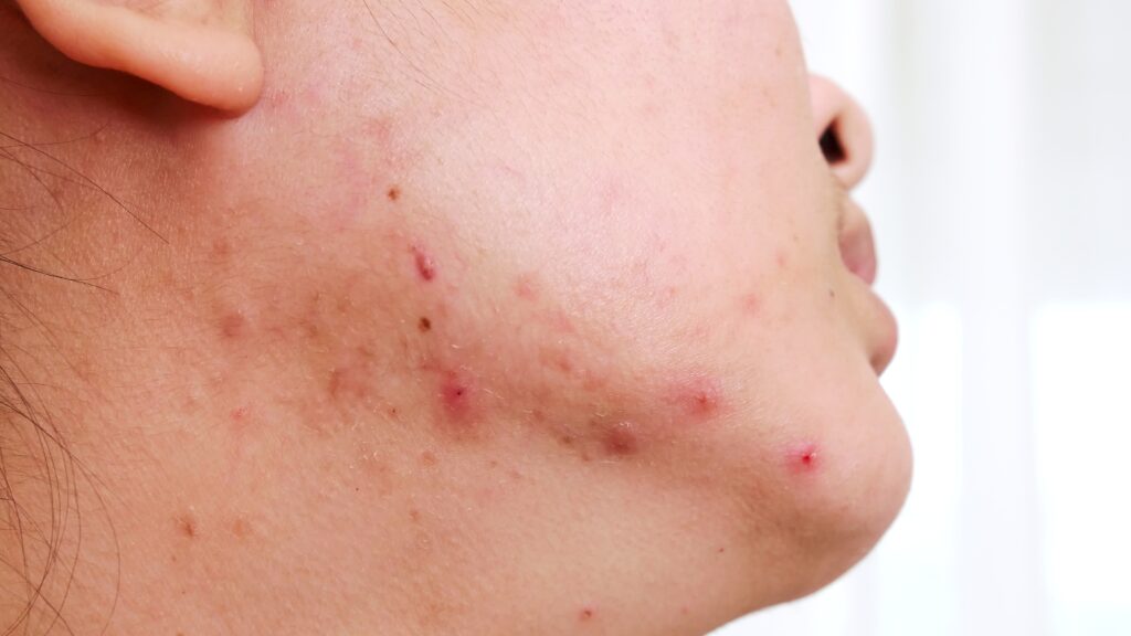 dermatologist in Pune for acne scars