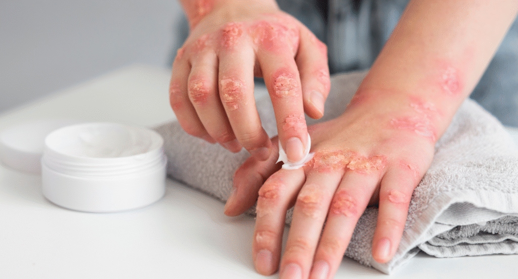 Fungal Infections Treatment in Pune